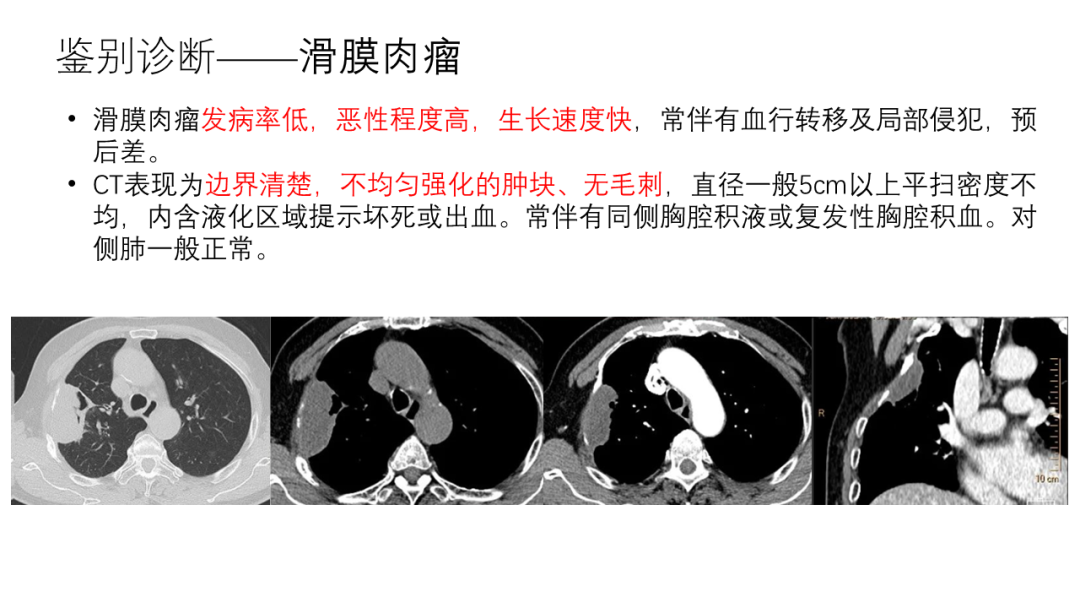 影像PPT - 【病例】胸膜孤立性纤维瘤2例CT影像-26