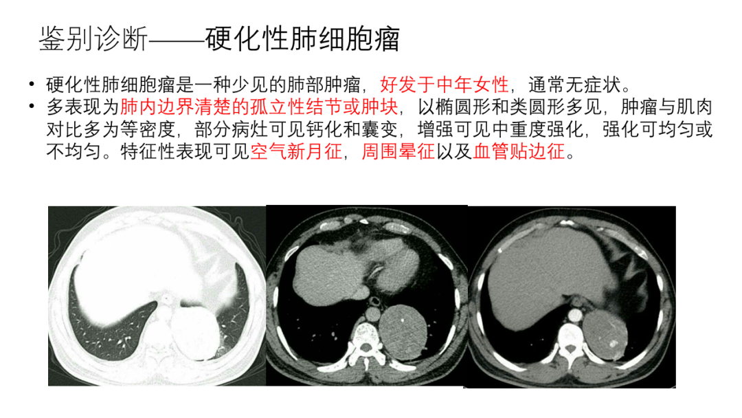 影像PPT - 【病例】胸膜孤立性纤维瘤2例CT影像-28