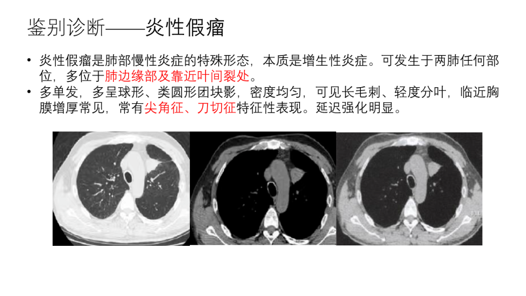 影像PPT - 【病例】胸膜孤立性纤维瘤2例CT影像-27