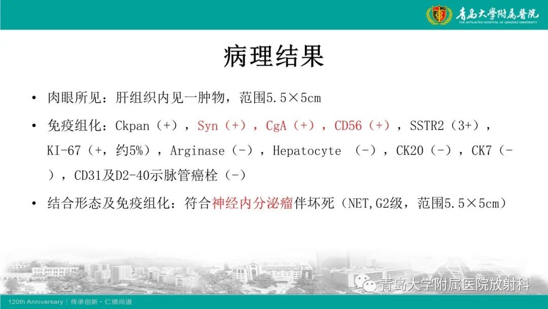 影像PPT - 【PPT】肝脏原发性神经内分泌肿瘤-7