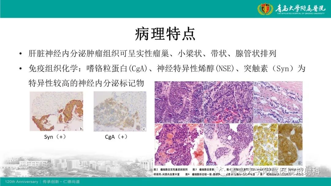 影像PPT - 【PPT】肝脏原发性神经内分泌肿瘤-12