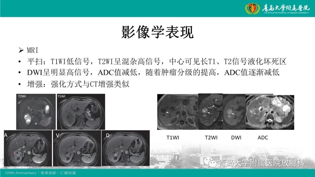 影像PPT - 【PPT】肝脏原发性神经内分泌肿瘤-15
