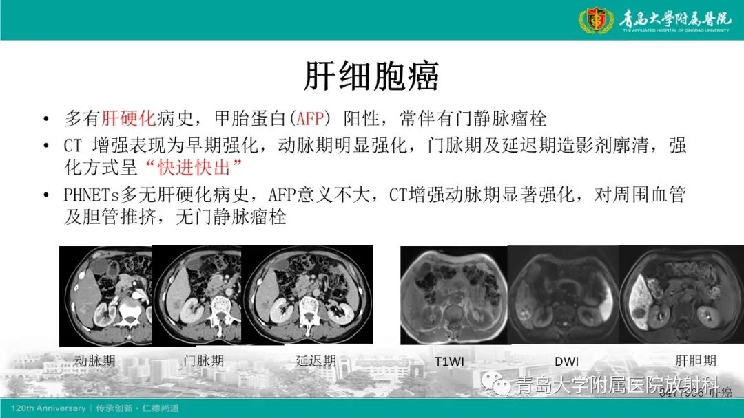 影像PPT - 【PPT】肝脏原发性神经内分泌肿瘤-17
