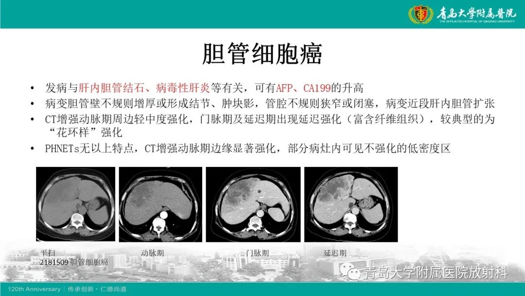 影像PPT - 【PPT】肝脏原发性神经内分泌肿瘤-18