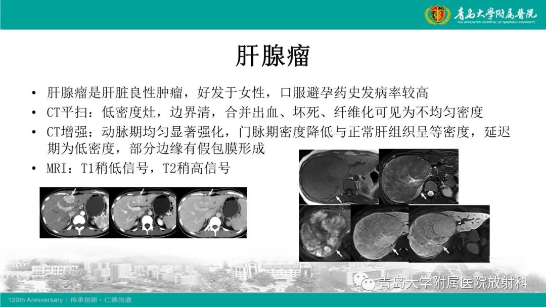 影像PPT - 【PPT】肝脏原发性神经内分泌肿瘤-19