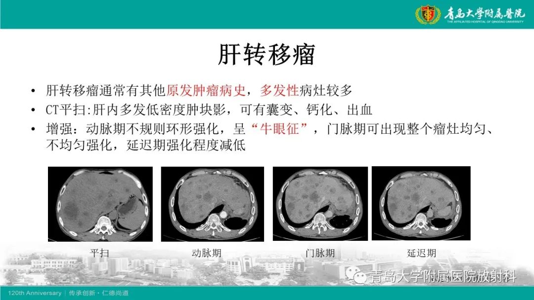 影像PPT - 【PPT】肝脏原发性神经内分泌肿瘤-20