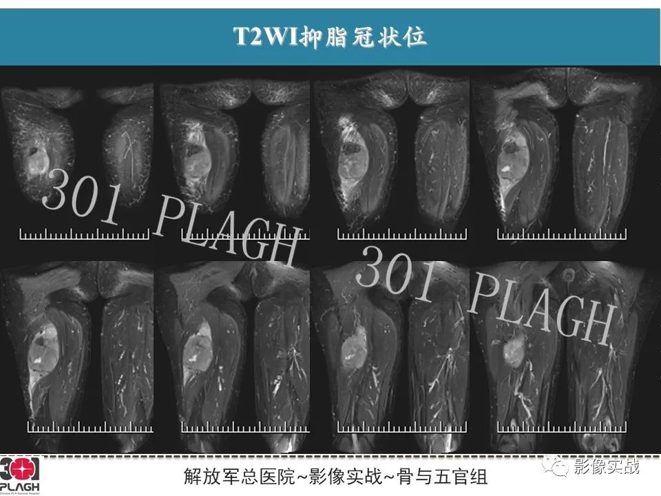 影像PPT - 【病例】大腿横纹肌肉瘤1例MR影像-4