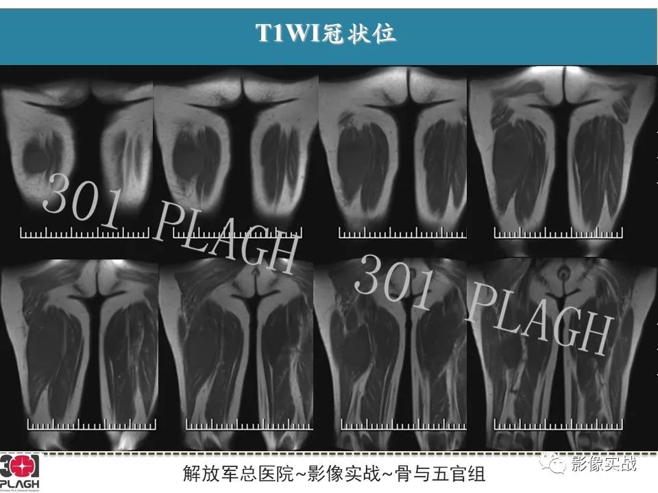 影像PPT - 【病例】大腿横纹肌肉瘤1例MR影像-3