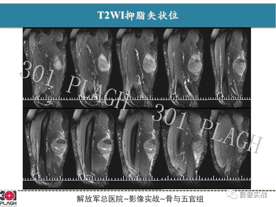 影像PPT - 【病例】大腿横纹肌肉瘤1例MR影像-5
