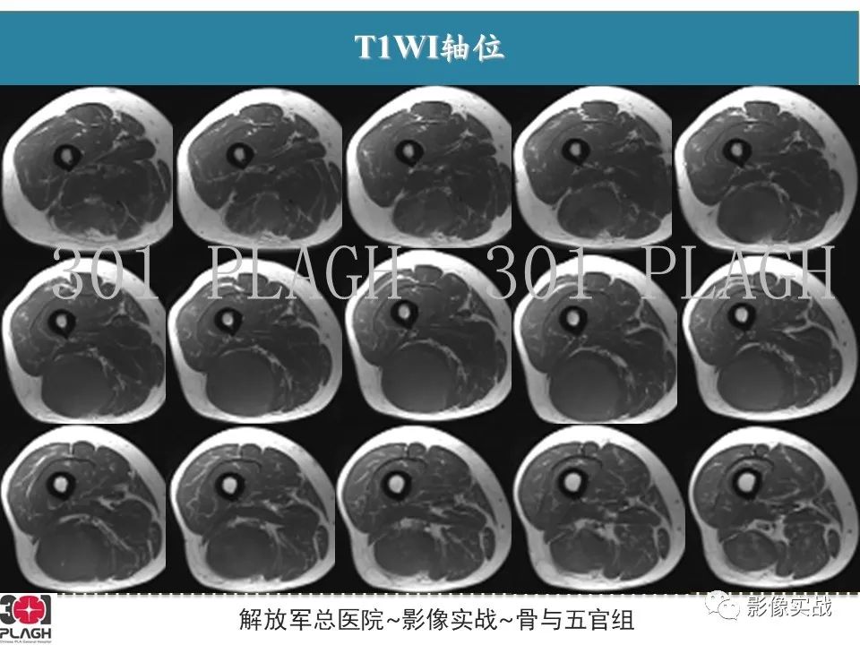 影像PPT - 【病例】大腿横纹肌肉瘤1例MR影像-6