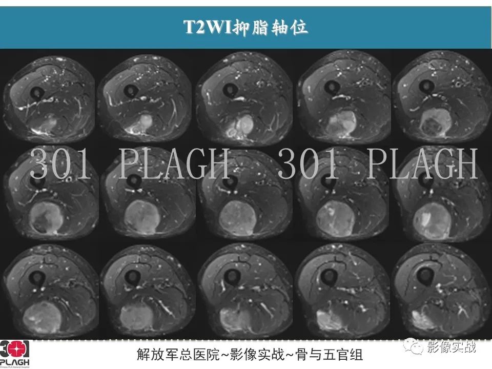 影像PPT - 【病例】大腿横纹肌肉瘤1例MR影像-7