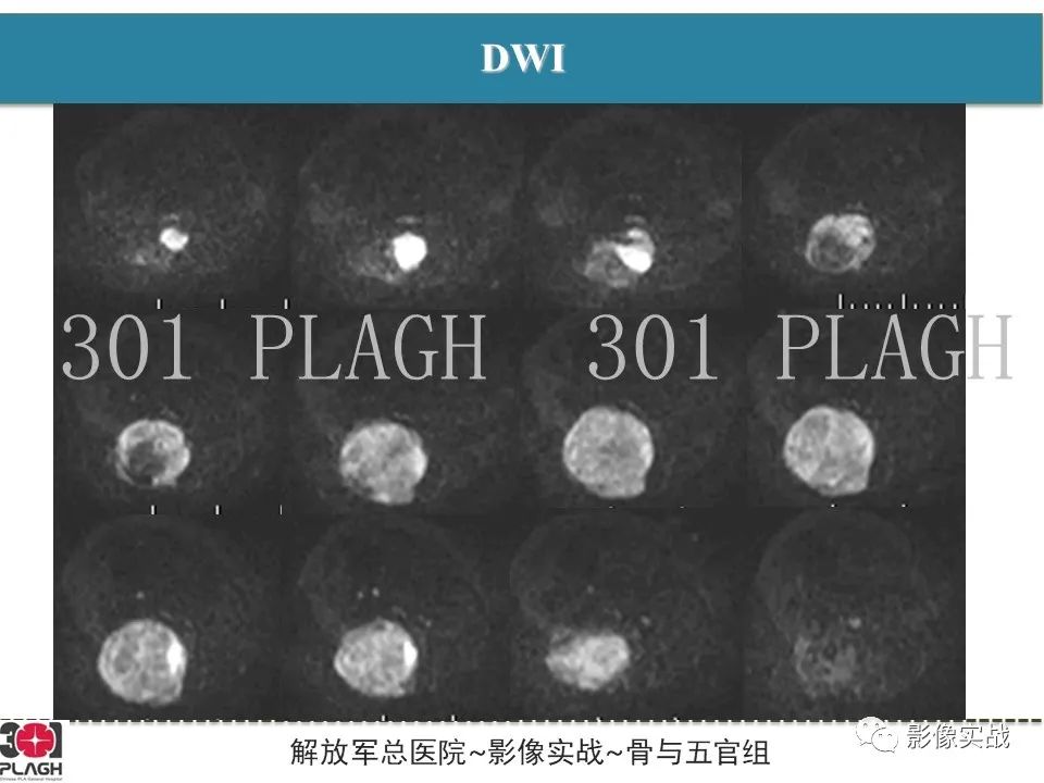 影像PPT - 【病例】大腿横纹肌肉瘤1例MR影像-8