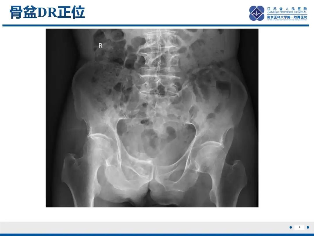 影像PPT - 【PPT】软骨肉瘤-3