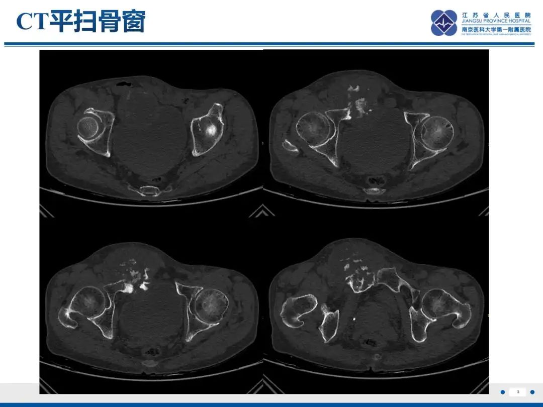影像PPT - 【PPT】软骨肉瘤-4