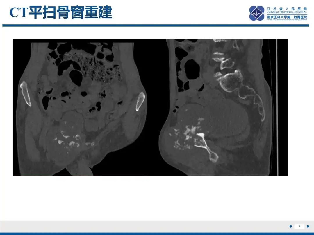 影像PPT - 【PPT】软骨肉瘤-5