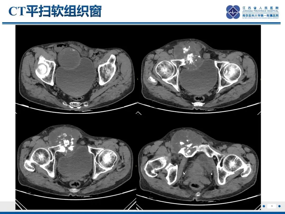 影像PPT - 【PPT】软骨肉瘤-6