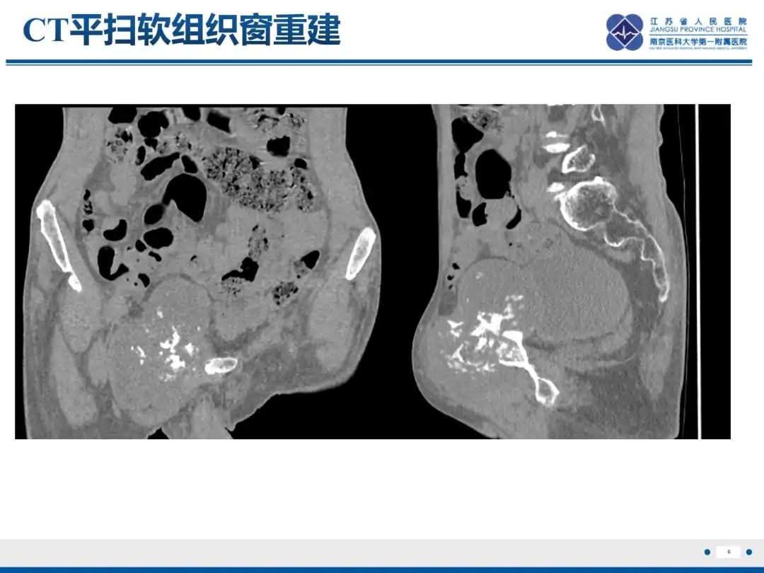 影像PPT - 【PPT】软骨肉瘤-7