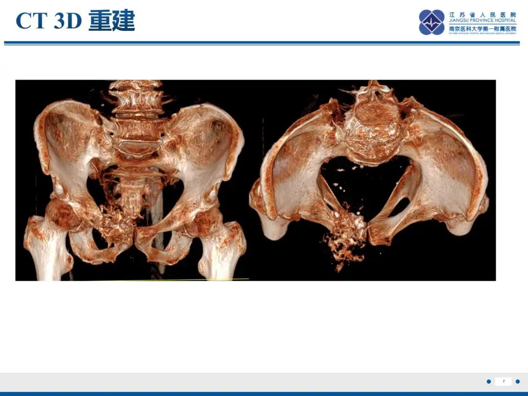 影像PPT - 【PPT】软骨肉瘤-8