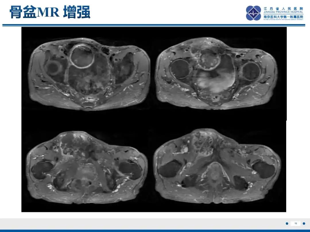 影像PPT - 【PPT】软骨肉瘤-13