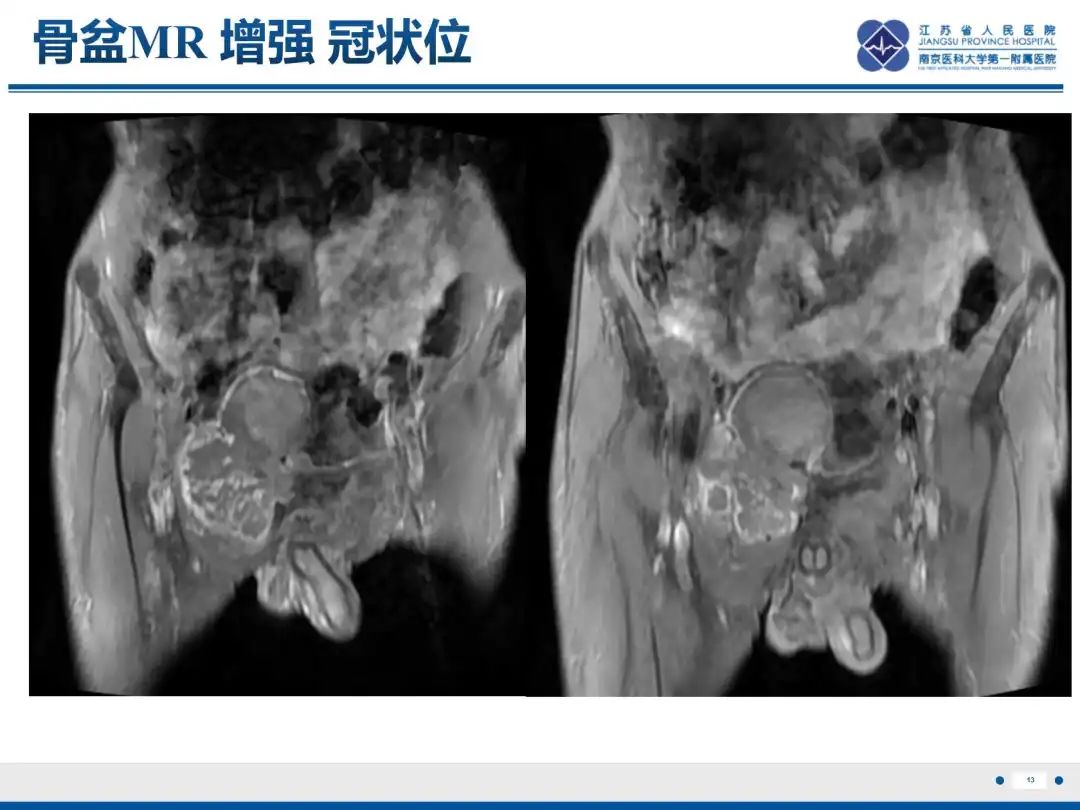 影像PPT - 【PPT】软骨肉瘤-14
