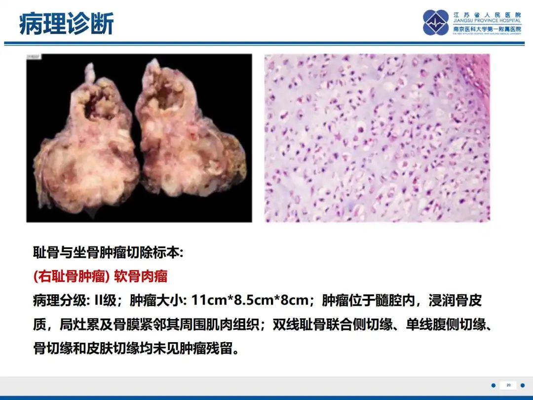 影像PPT - 【PPT】软骨肉瘤-21
