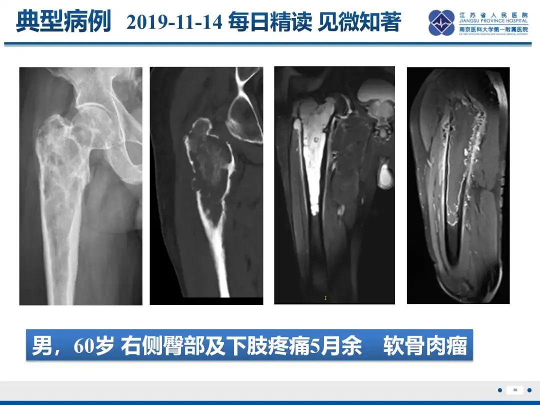 影像PPT - 【PPT】软骨肉瘤-31