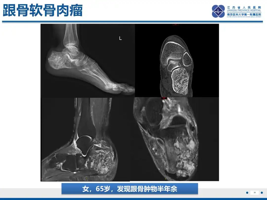 影像PPT - 【PPT】软骨肉瘤-32