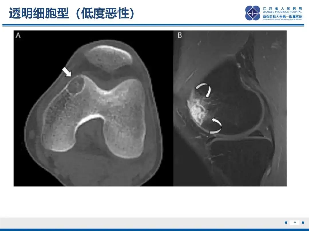 影像PPT - 【PPT】软骨肉瘤-33