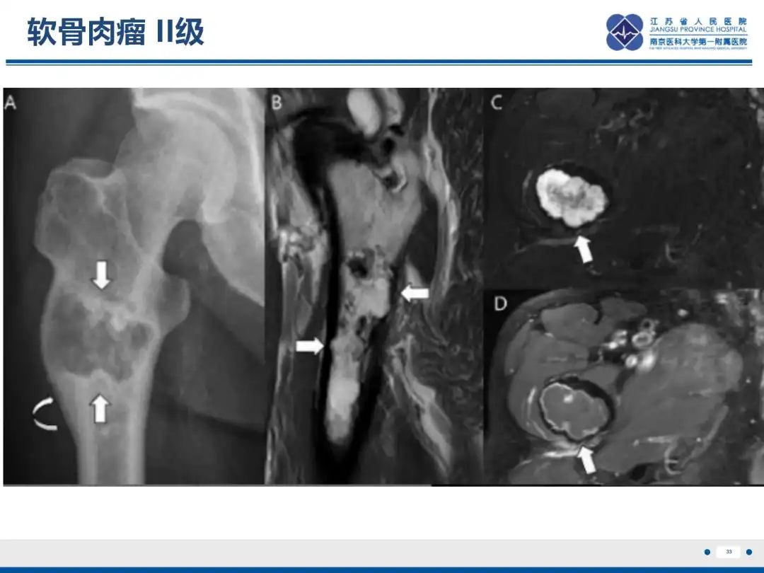 影像PPT - 【PPT】软骨肉瘤-34