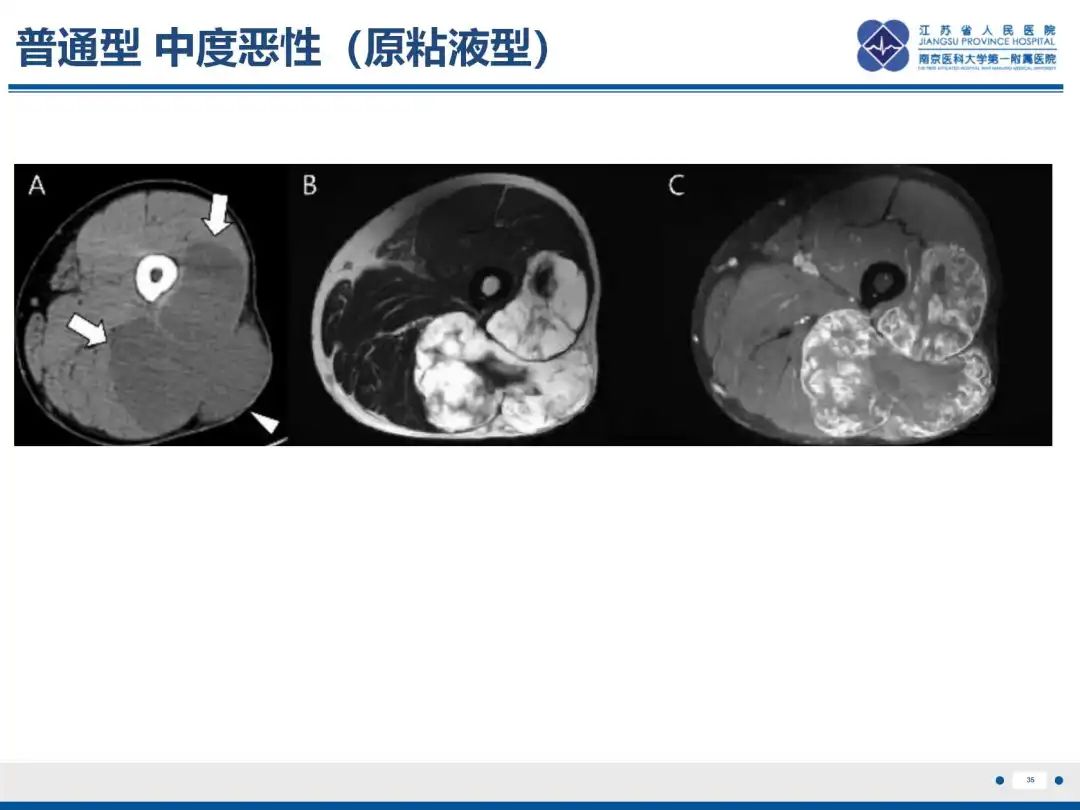 影像PPT - 【PPT】软骨肉瘤-36