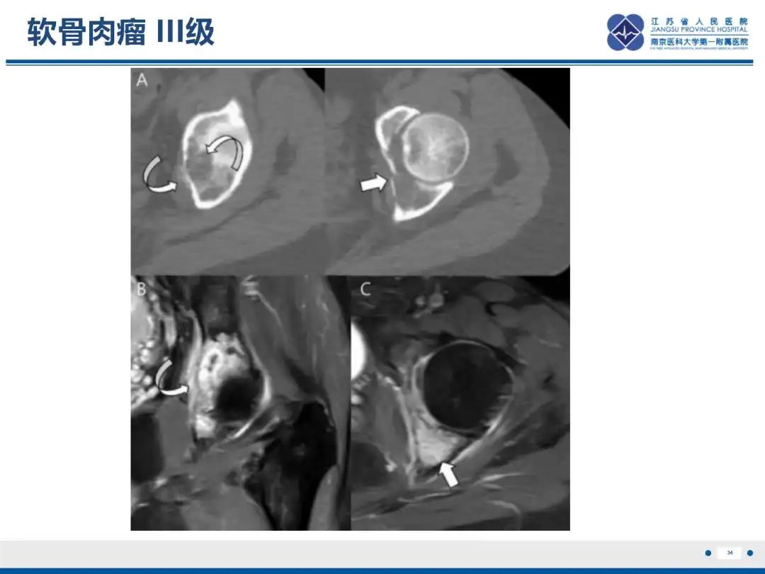 影像PPT - 【PPT】软骨肉瘤-35