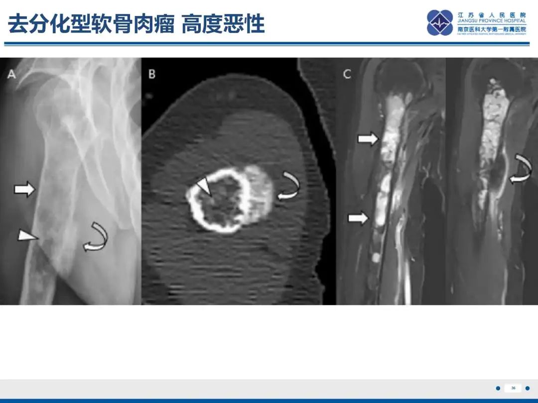 影像PPT - 【PPT】软骨肉瘤-37