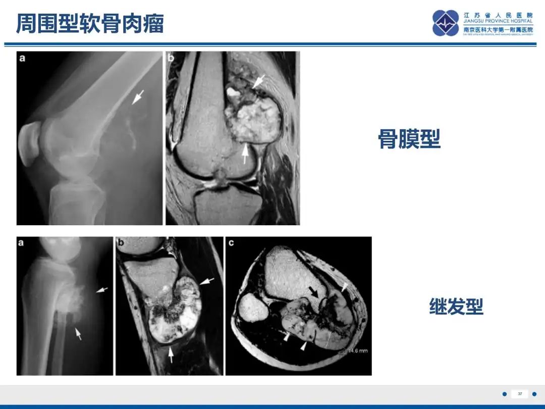影像PPT - 【PPT】软骨肉瘤-38