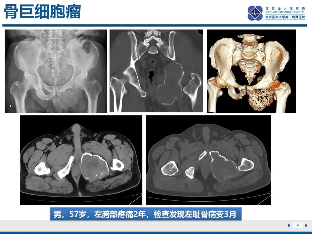 影像PPT - 【PPT】软骨肉瘤-43