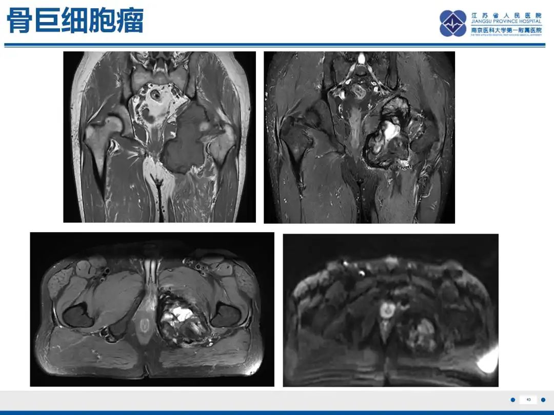 影像PPT - 【PPT】软骨肉瘤-44