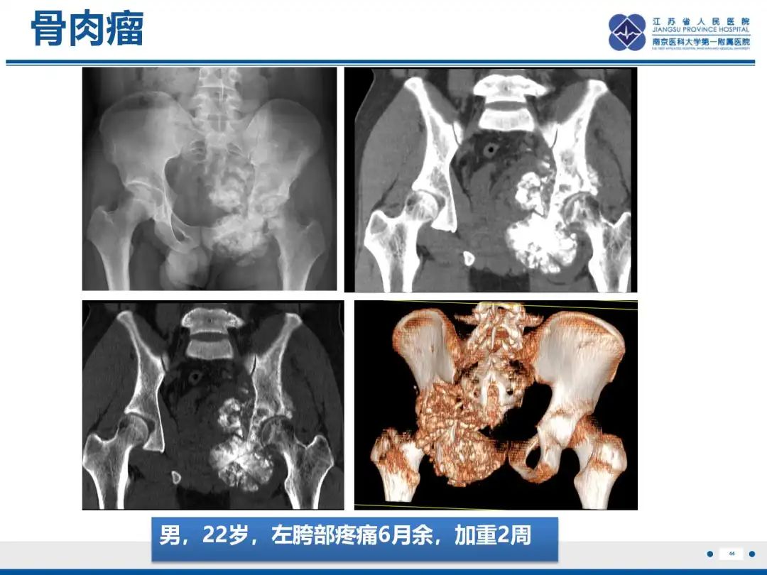 影像PPT - 【PPT】软骨肉瘤-45