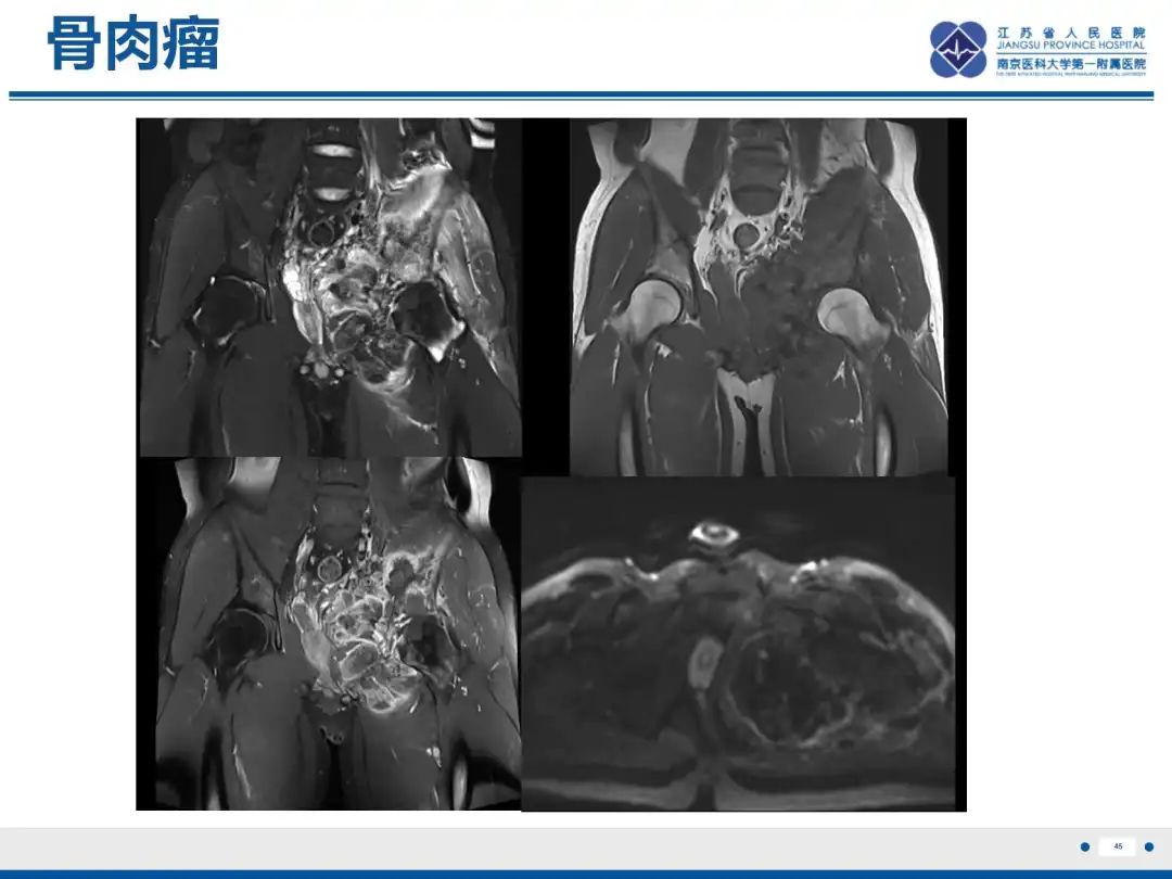 影像PPT - 【PPT】软骨肉瘤-46