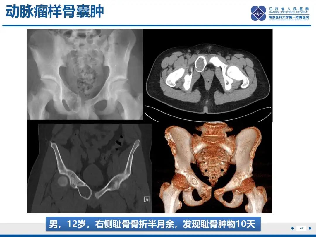 影像PPT - 【PPT】软骨肉瘤-47