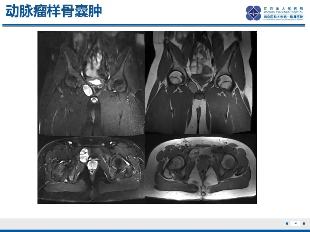 影像PPT - 【PPT】软骨肉瘤-48