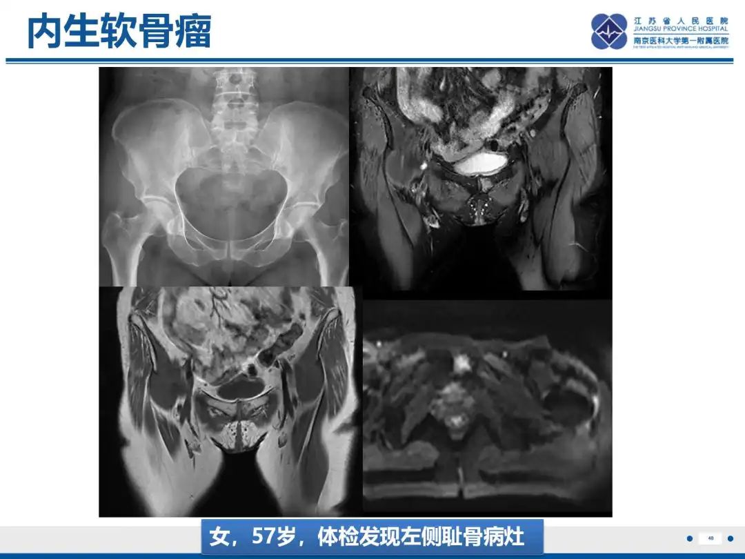 影像PPT - 【PPT】软骨肉瘤-49