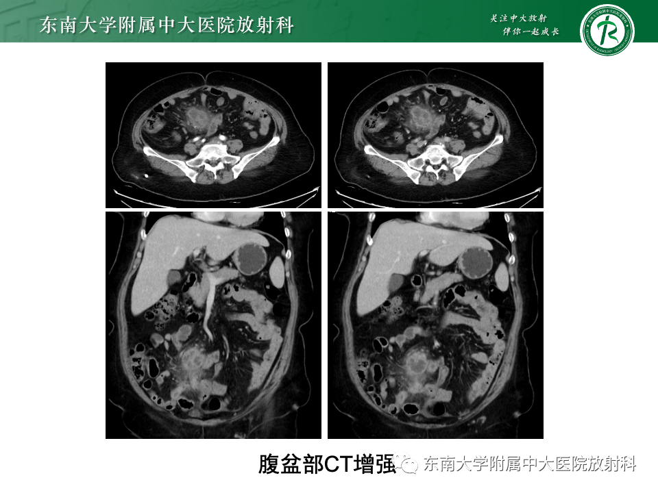 影像PPT - 【PPT】腹部脂肪坏死的影像诊断及主要鉴别-3