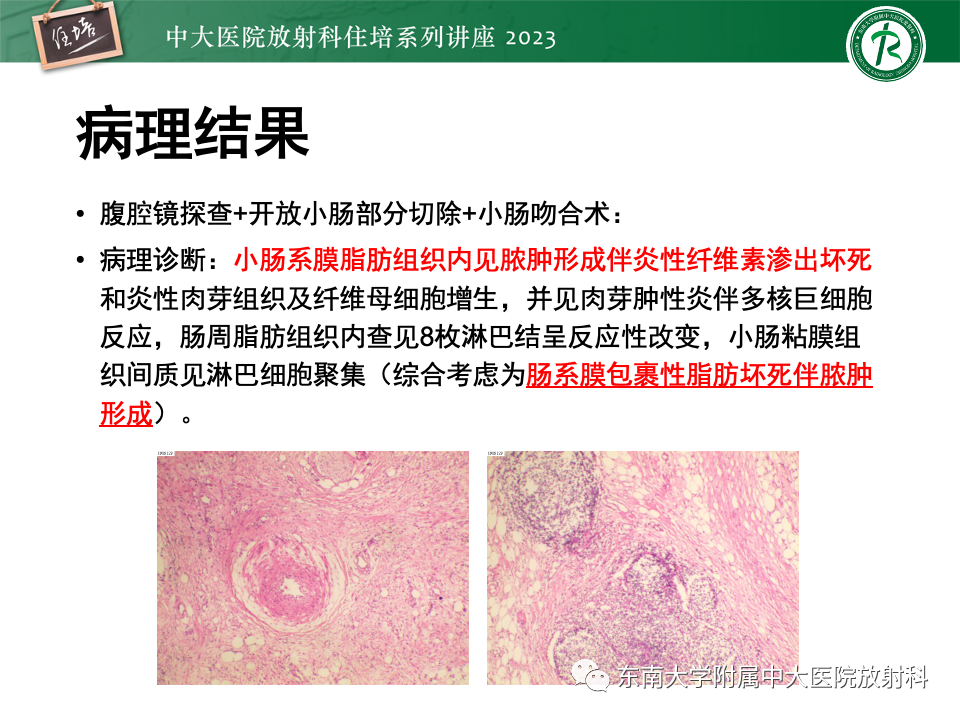 影像PPT - 【PPT】腹部脂肪坏死的影像诊断及主要鉴别-4