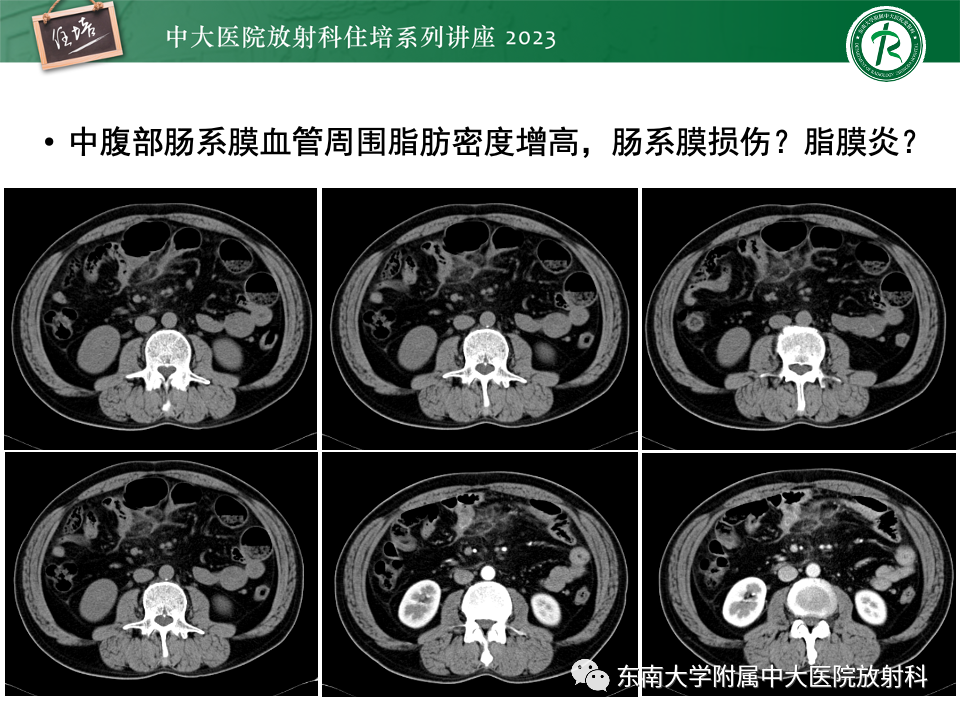 影像PPT - 【PPT】腹部脂肪坏死的影像诊断及主要鉴别-6