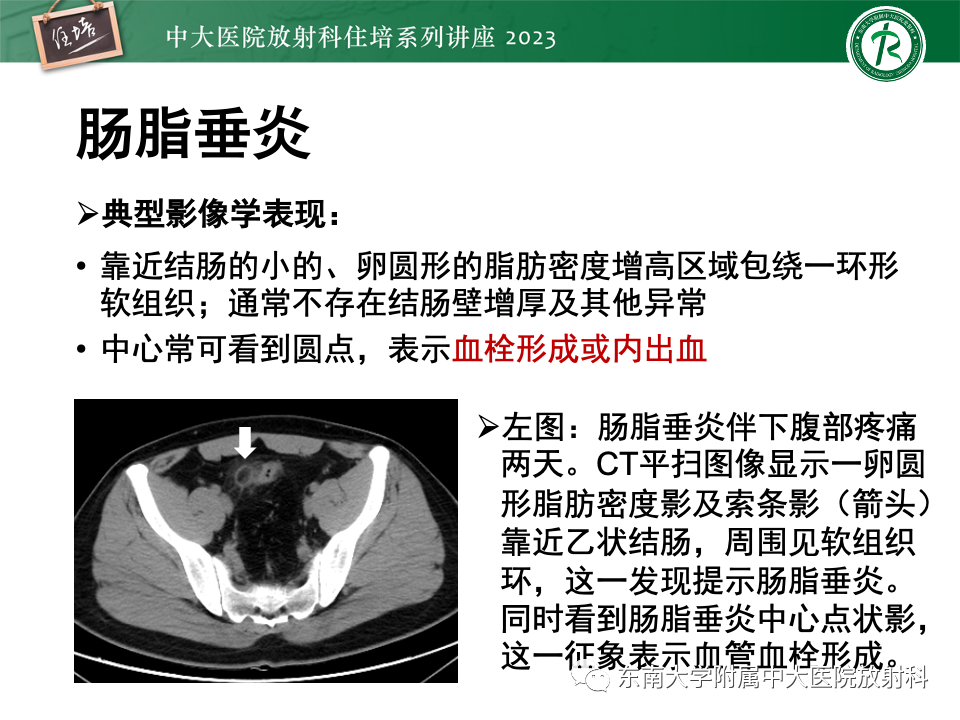 影像PPT - 【PPT】腹部脂肪坏死的影像诊断及主要鉴别-16
