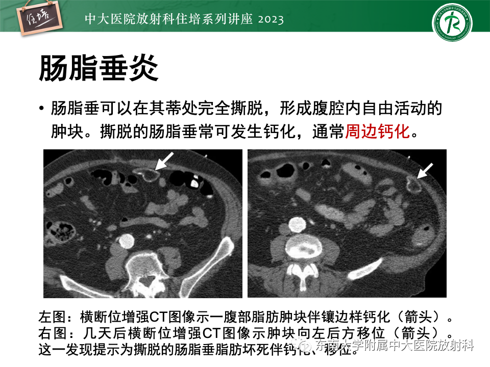 影像PPT - 【PPT】腹部脂肪坏死的影像诊断及主要鉴别-17