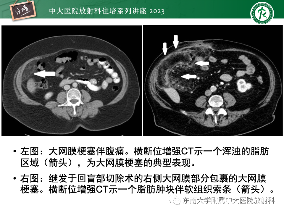 影像PPT - 【PPT】腹部脂肪坏死的影像诊断及主要鉴别-21