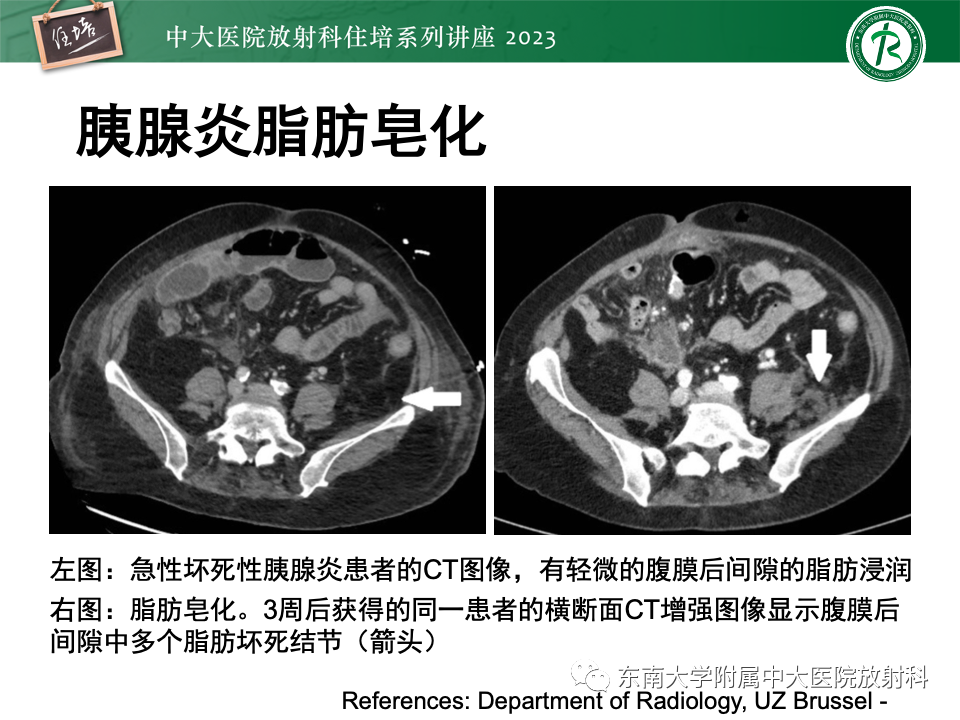 影像PPT - 【PPT】腹部脂肪坏死的影像诊断及主要鉴别-23