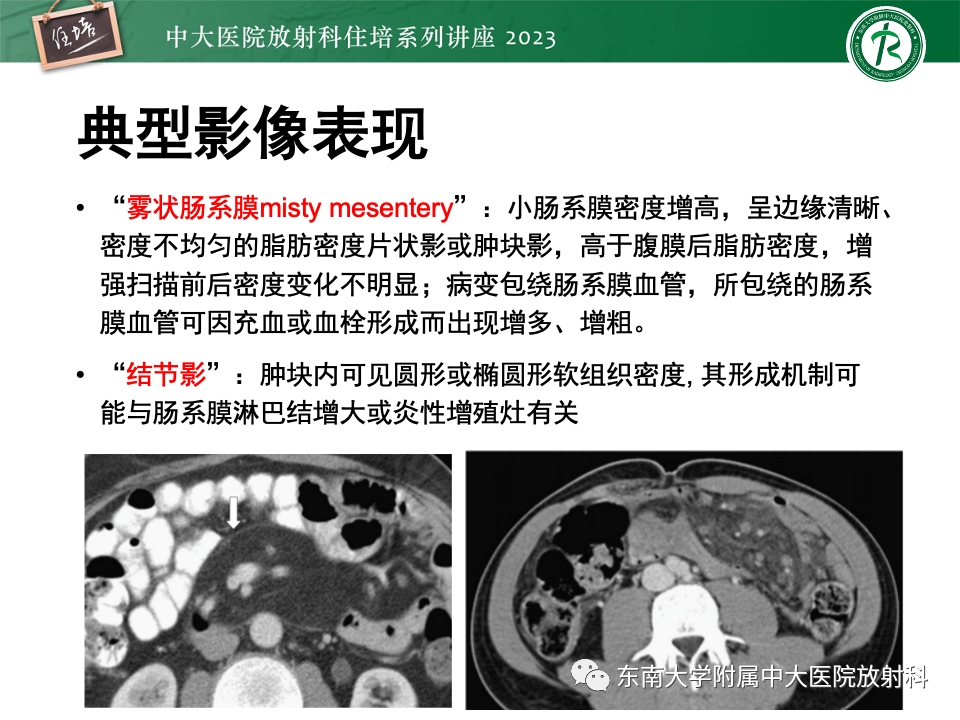 影像PPT - 【PPT】腹部脂肪坏死的影像诊断及主要鉴别-26