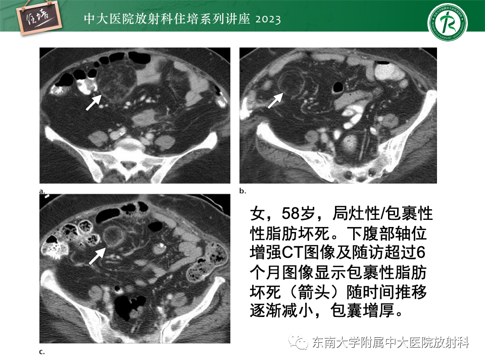 影像PPT - 【PPT】腹部脂肪坏死的影像诊断及主要鉴别-32