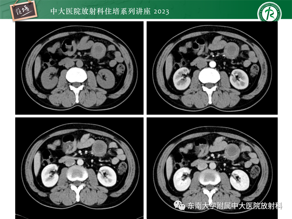 影像PPT - 【PPT】腹部脂肪坏死的影像诊断及主要鉴别-29